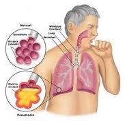 pneumonia image