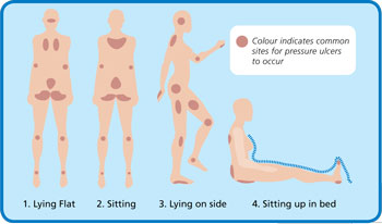 pressure ulcers locations